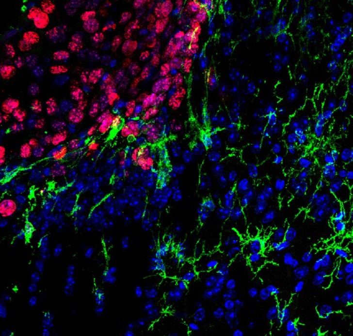 Nuevas estrategias para frenar metástasis cerebrales en melanoma agresivo